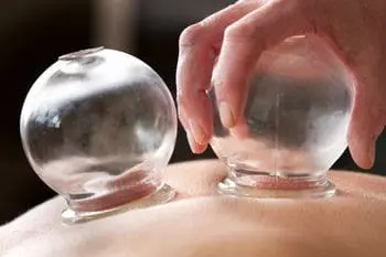 What is Cupping