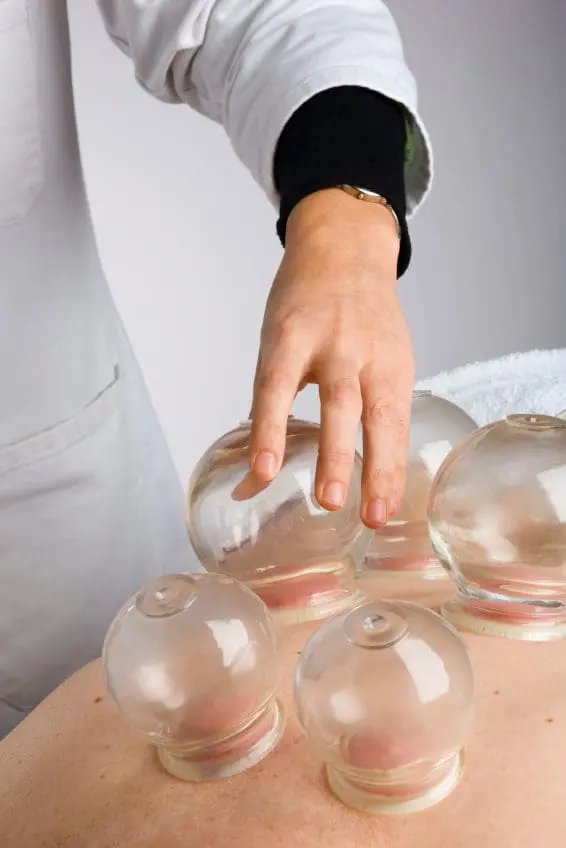 cupping, acupuncture, scottsdale, az