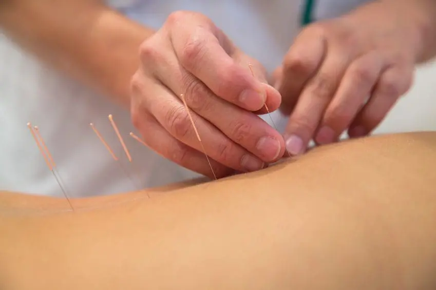 acupuncture, acupuncturist, scottsdale