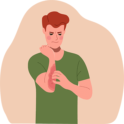 Vector illustration of a man scratching a rash on his arm, symbolizing treatment for skin conditions.