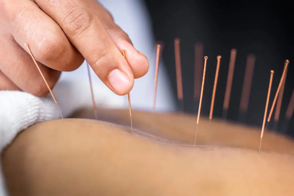 Close-up of a practitioner inserting acupuncture needles into a patient’s back, highlighting holistic healing and precise treatment.