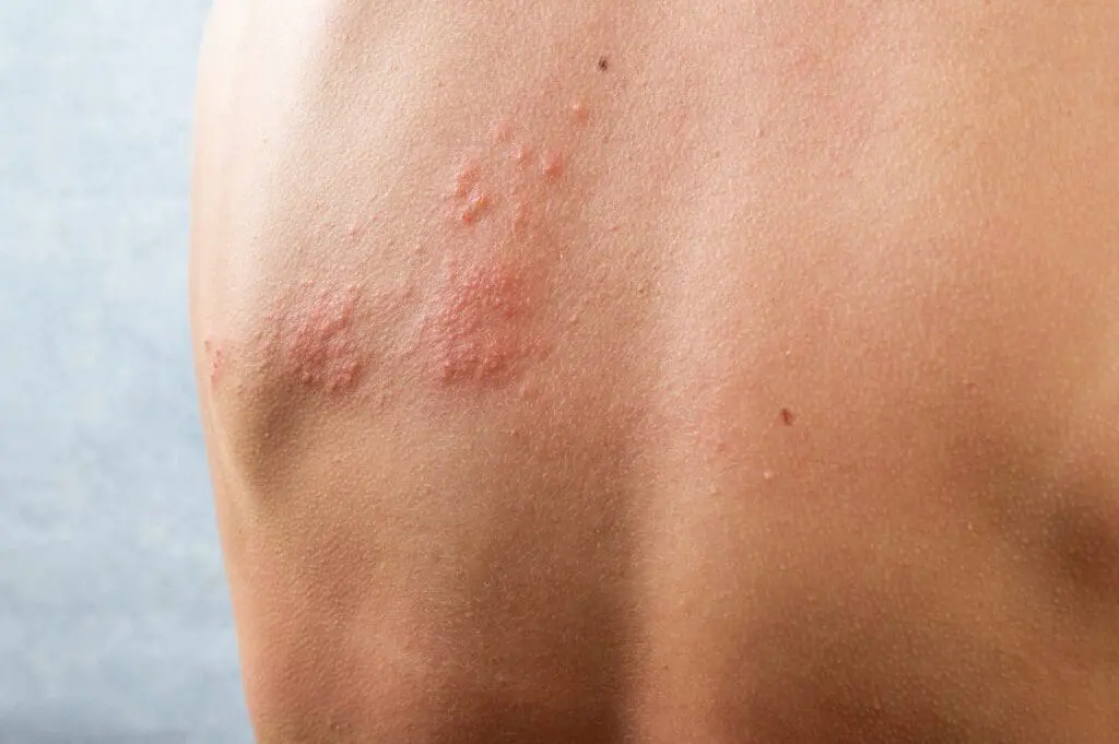 Close-up of a man's back showing a shingles outbreak on his shoulder blade, illustrating symptoms discussed in the Treatment blog post, 'Holistically Treating Shingles'.
