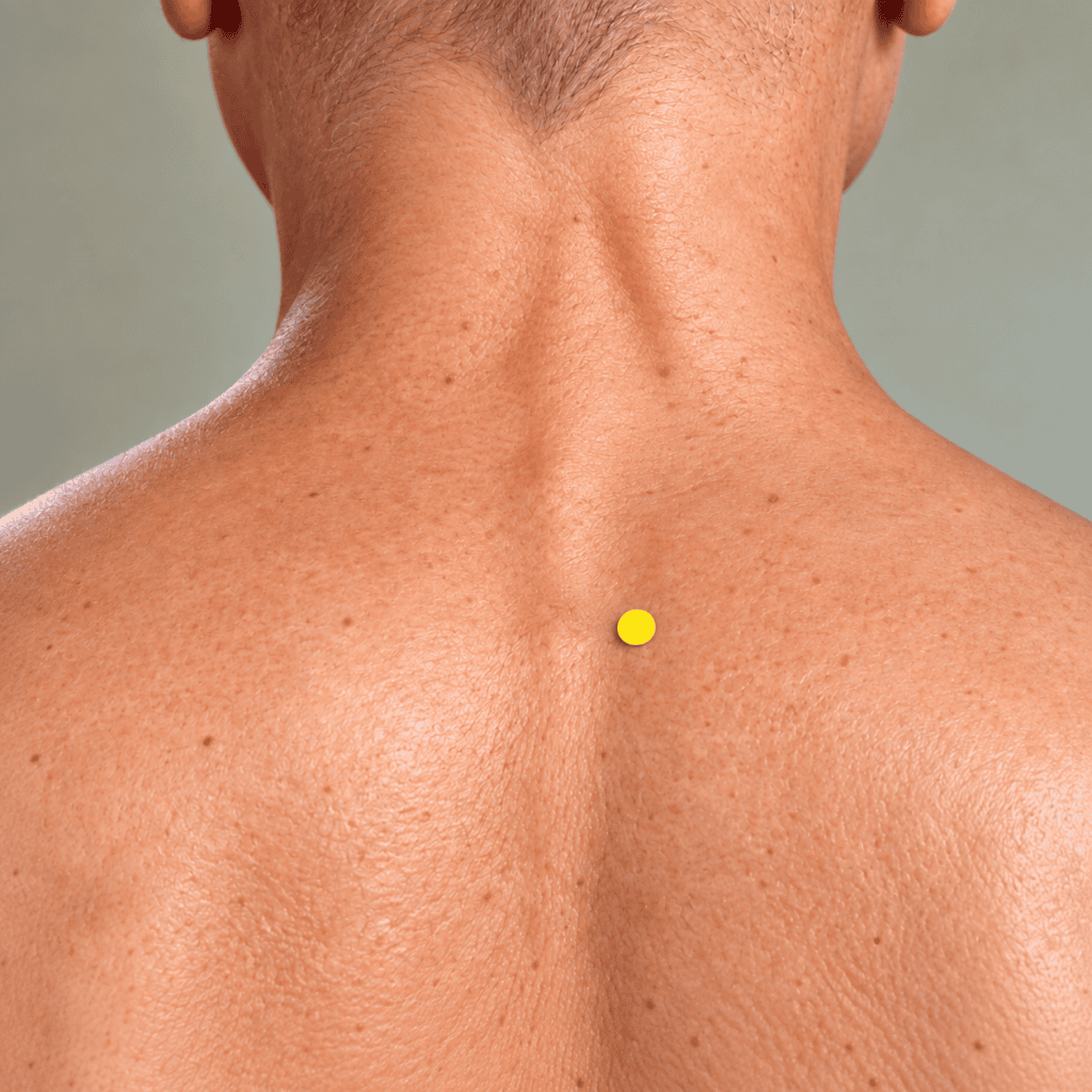 Close-up of the base of the neck with yellow dot markers half a thumb-width to each side of the prominent vertebra, indicating Dingchuan.