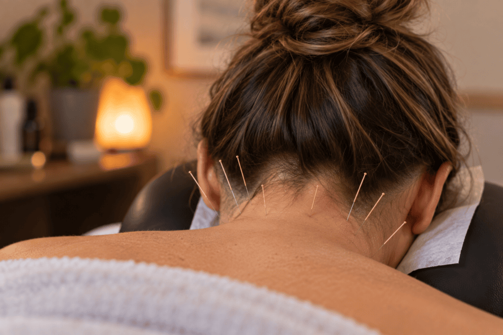 Close-up of fine acupuncture needles in the muscles at the base of the skull and upper neck.