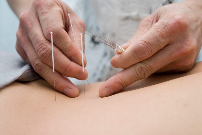 acupuncture, treatment, scottsdale, AZ