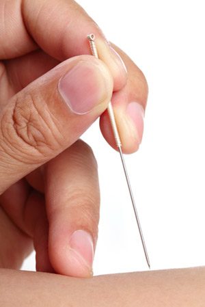 Acupuncture FAQ