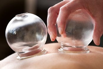 What is Cupping