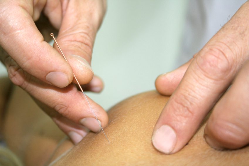 acupuncture, needle, pain, sensation