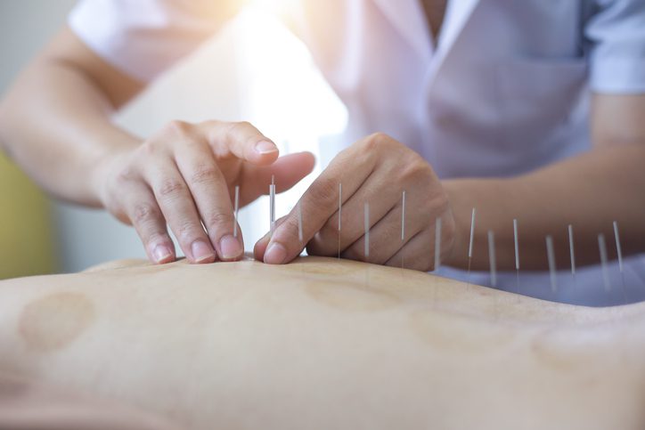 Can Acupuncture Help Me Heal Above Beyond Acupuncture Scottsdale Acupuncture