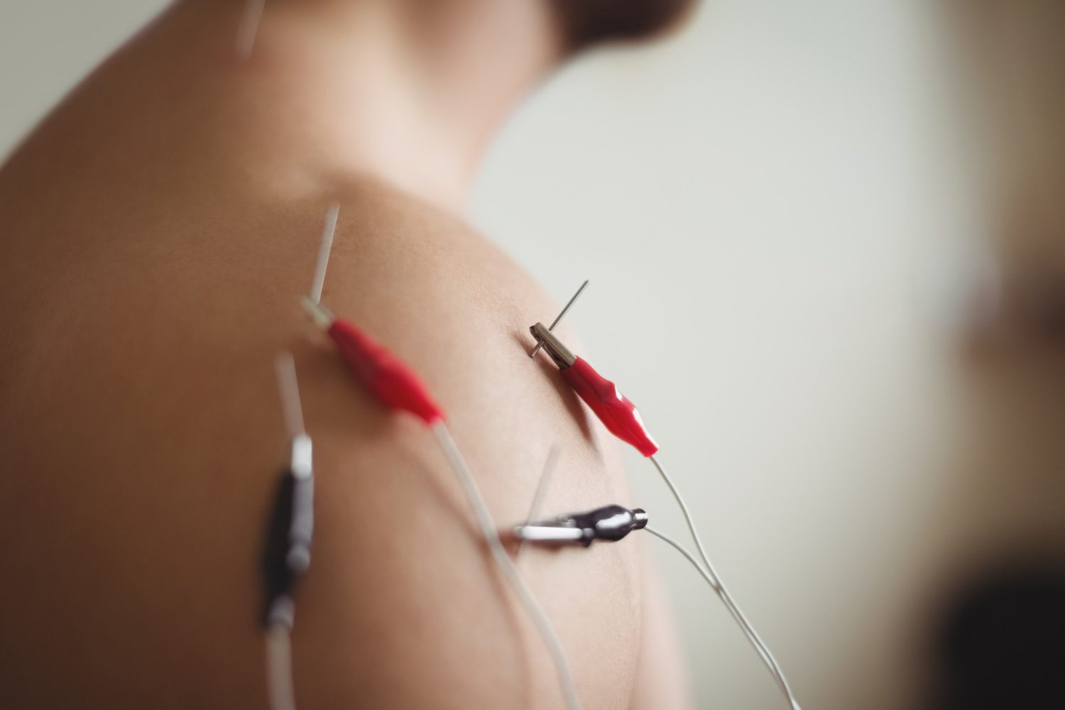 Close-up of a patient receiving an electroacupuncture treatment on their shoulder at a Scottsdale acupuncture clinic.