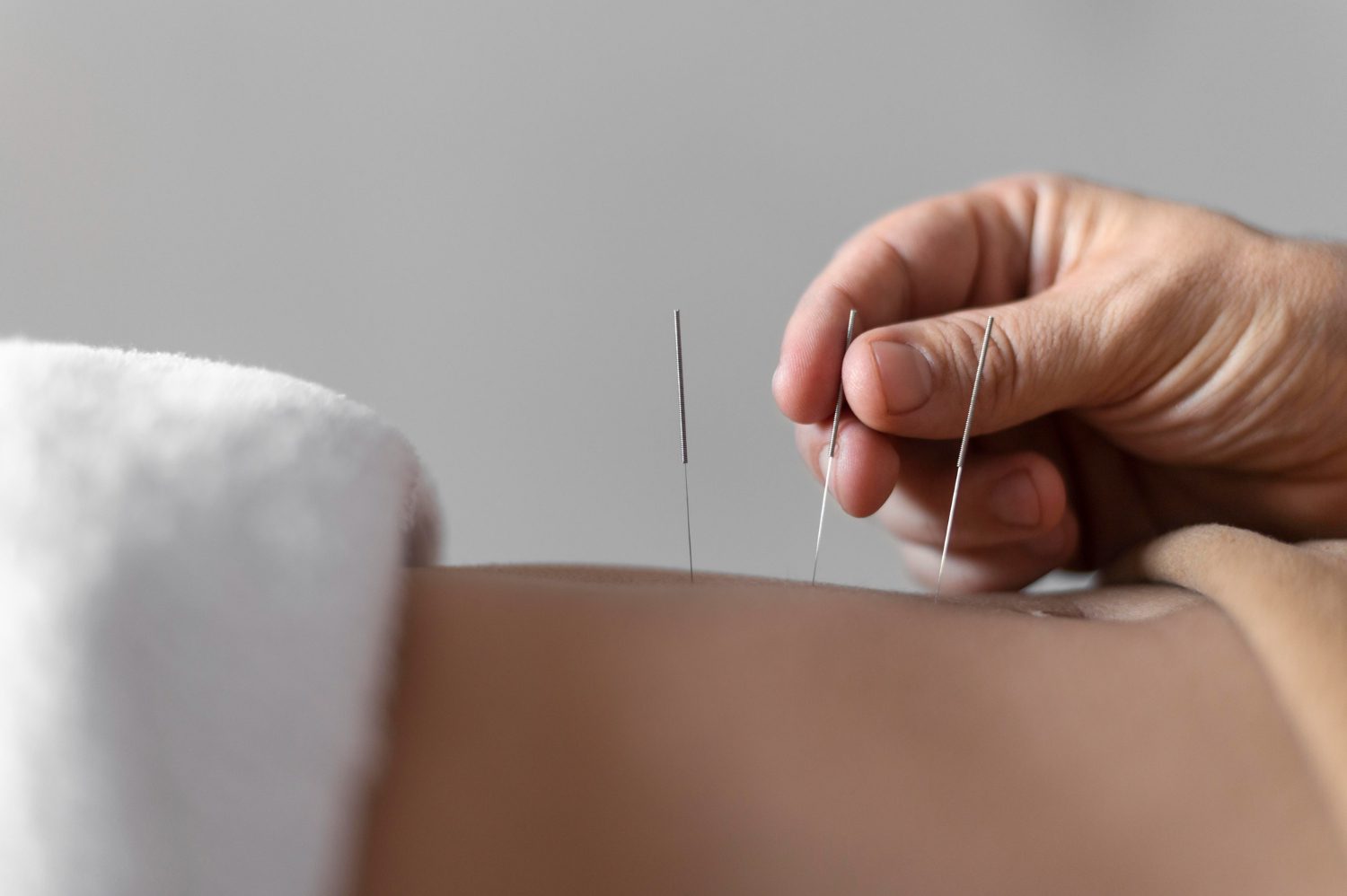 Close-up of a practitioner's hand carefully inserting fine acupuncture needles into a patient's abdomen during a session.